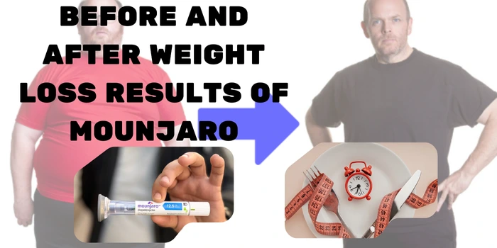 Before and after weight loss results of mounjaro