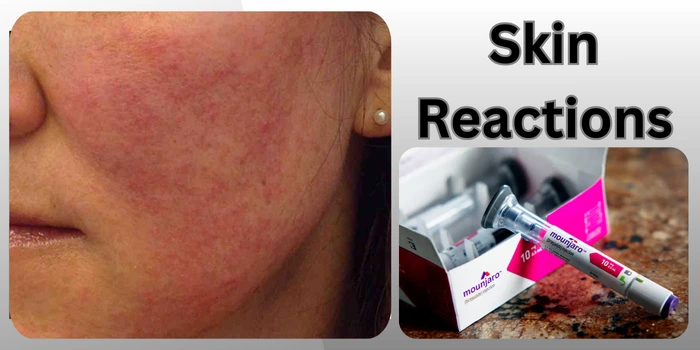 Skin Reactions